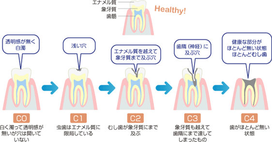 むし歯の進行の様子